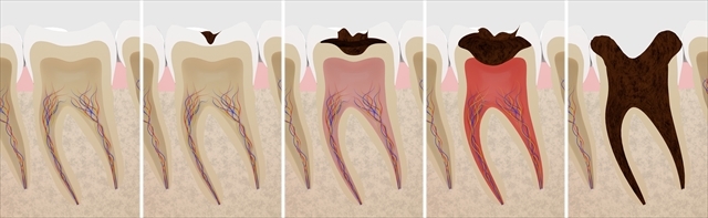 虫歯の進行