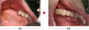 症例1　奥歯2本欠損
